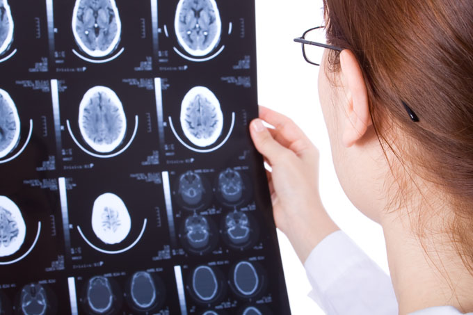 traumatic brain injury trial lawyer